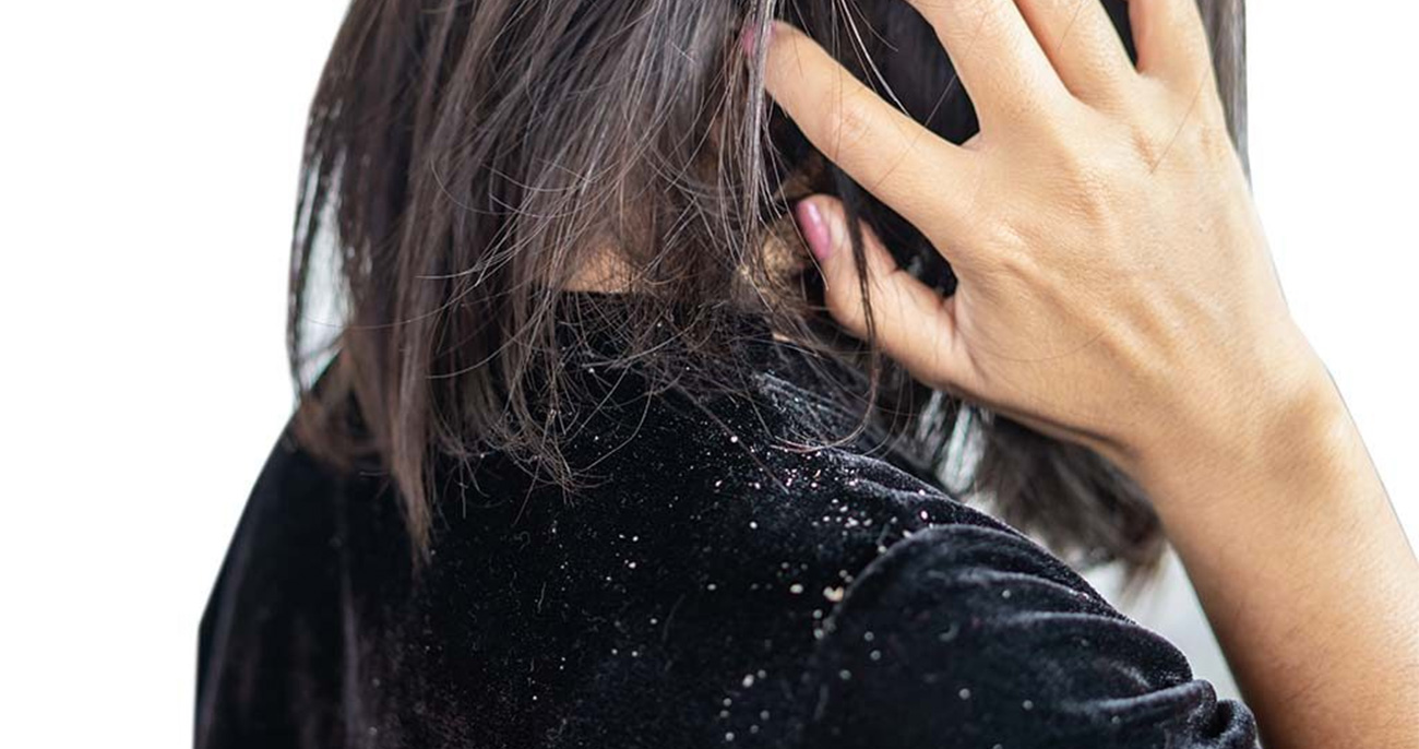 You are currently viewing Dandruff Treatment