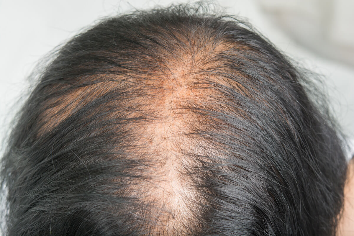 Female Pattern Hair Loss Treatment