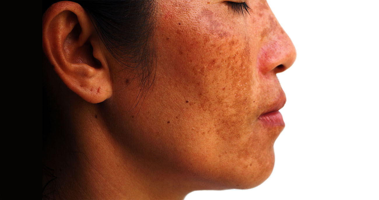 You are currently viewing Melasma Treatment
