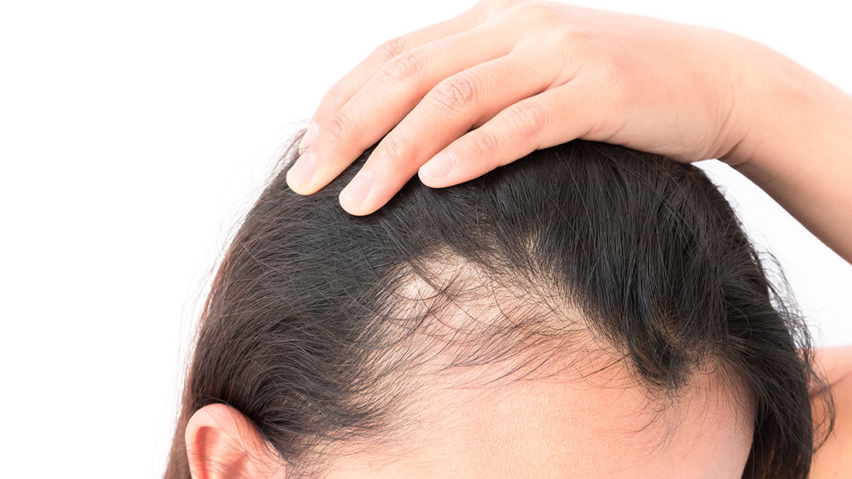 Hair Loss Treatment