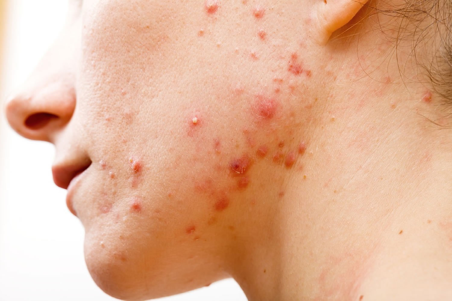 Acne Treatment - The Lifestyle Clinic