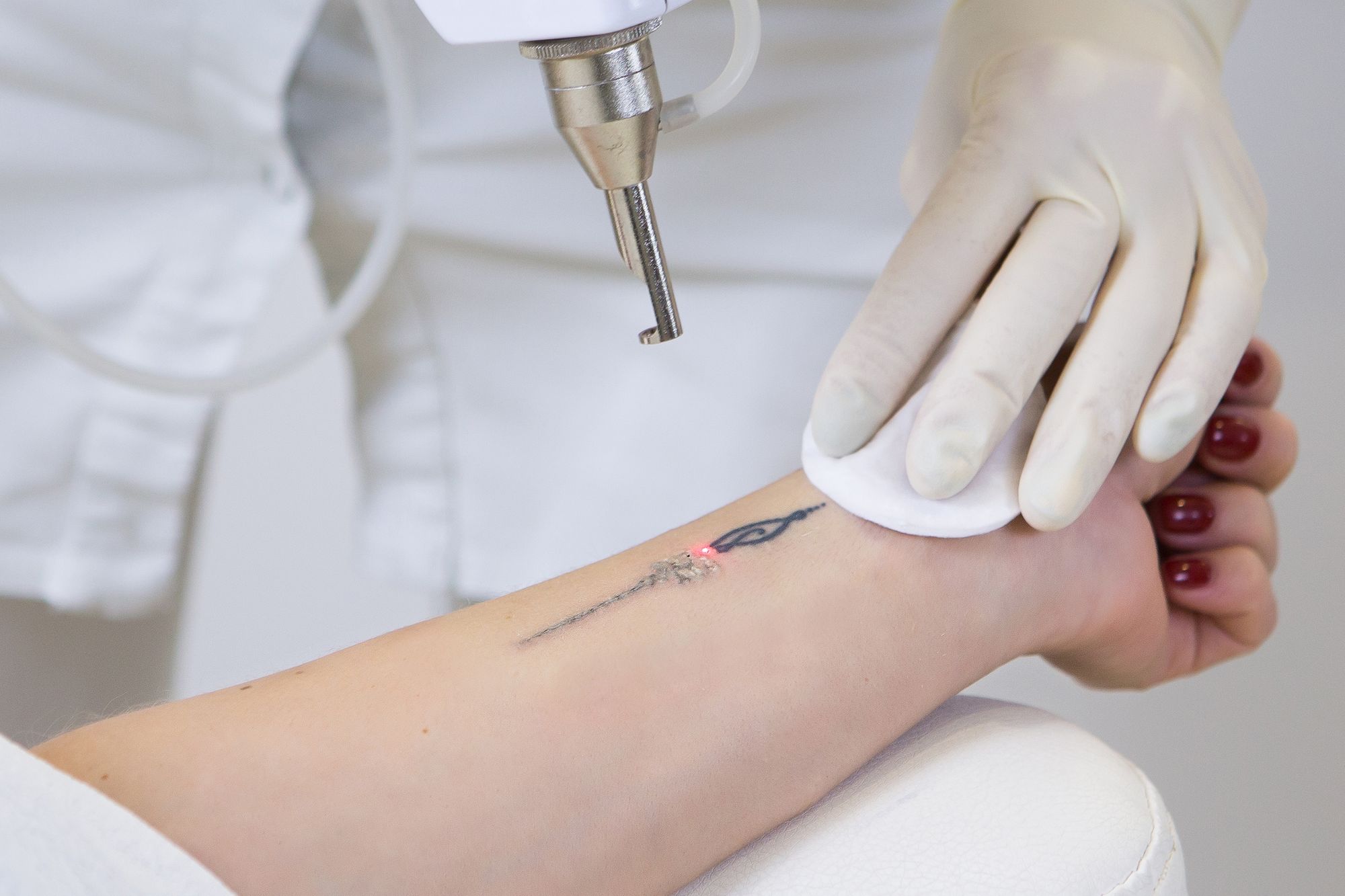 Tattoo removal available in vampire needle tattoo studio | Instagram