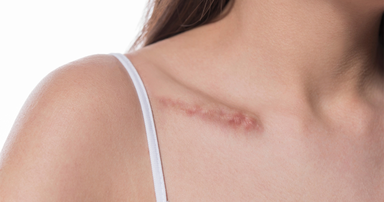 Scars Treatment | Keloid, Hypertrophic, Atrophic Scars | The Lifestyle  Clinic